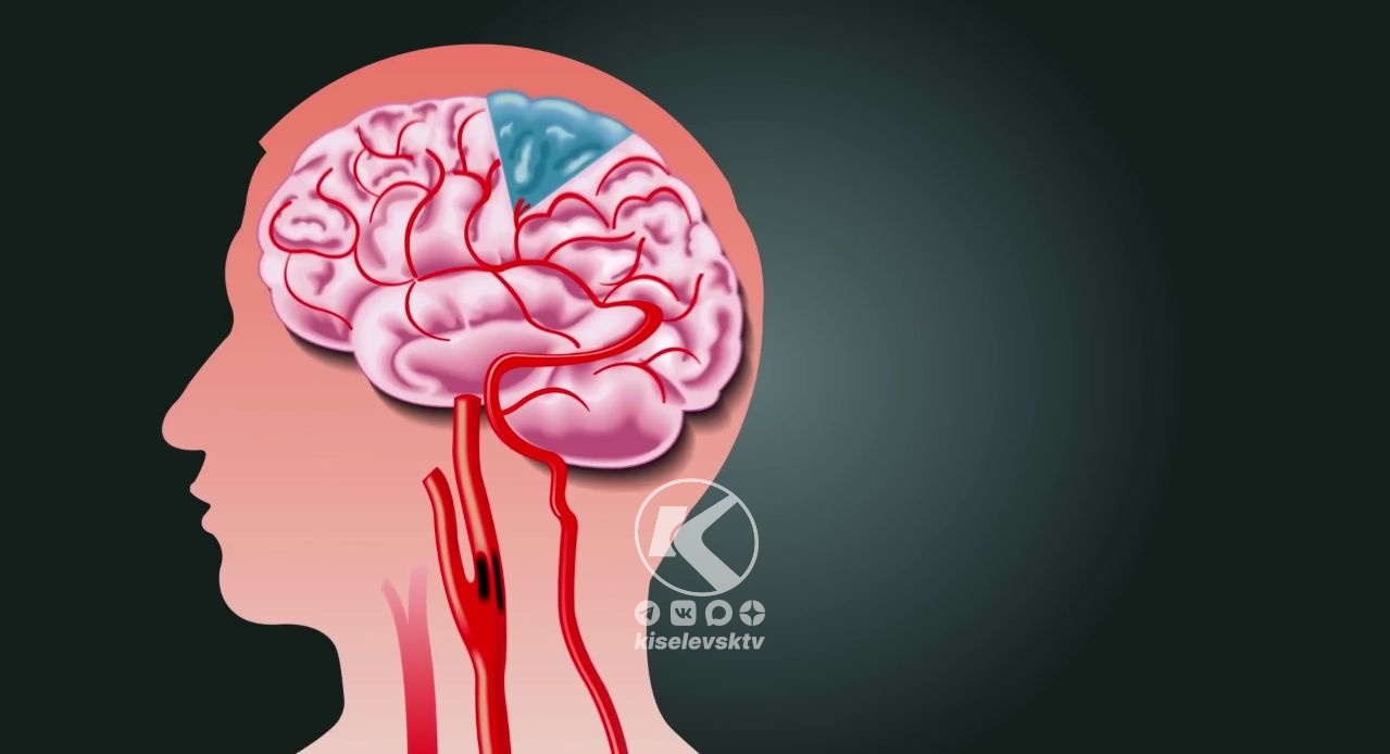 Инсульт – одно из самых грозных осложнений сердечно-сосудистых заболеваний